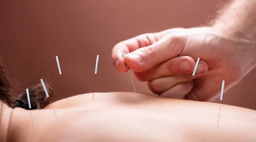 Les bienfaits de l’Acupuncture